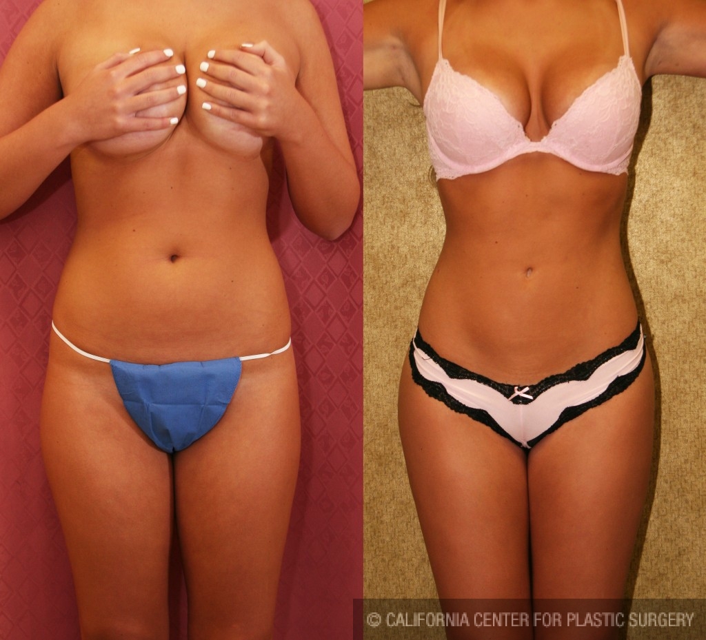 Patient Liposuction Abdomen Medium Before And After Photos Encino