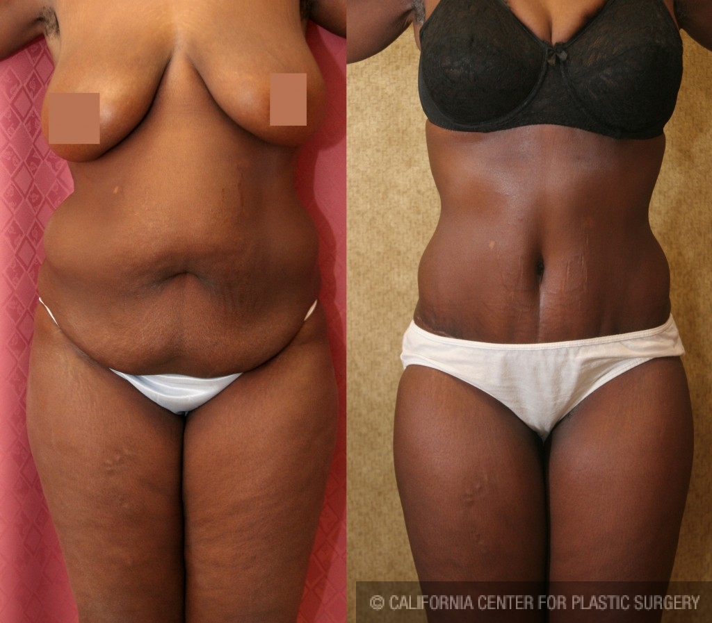 Patient African American Tummy Tuck Before And After Photos