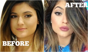Kylie Jenner Before & After