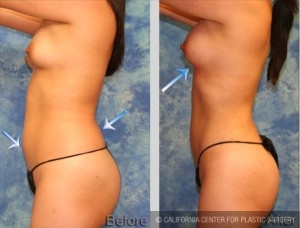 Breast Augmentation Fat Transfer Before & After