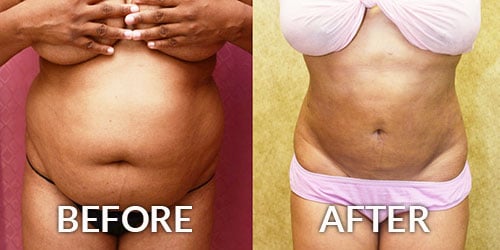 Best Tummy Tuck Scar Encino & Bakersfield