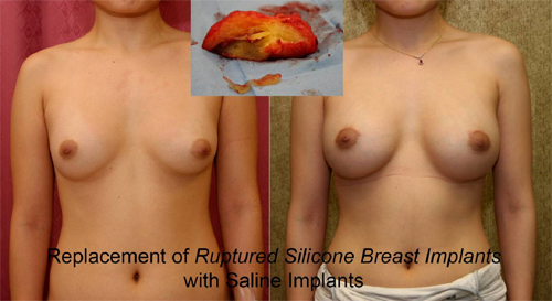 Breast implant removal 