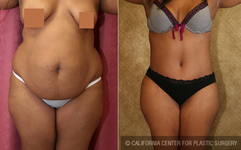 African American Tummy Tuck (Abdominoplasty) Before & After Patient #5957