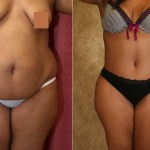 African American Tummy Tuck (Abdominoplasty) Before & After Patient #5957