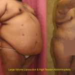 Male Liposuction Abdomen Before & After Patient #5617
