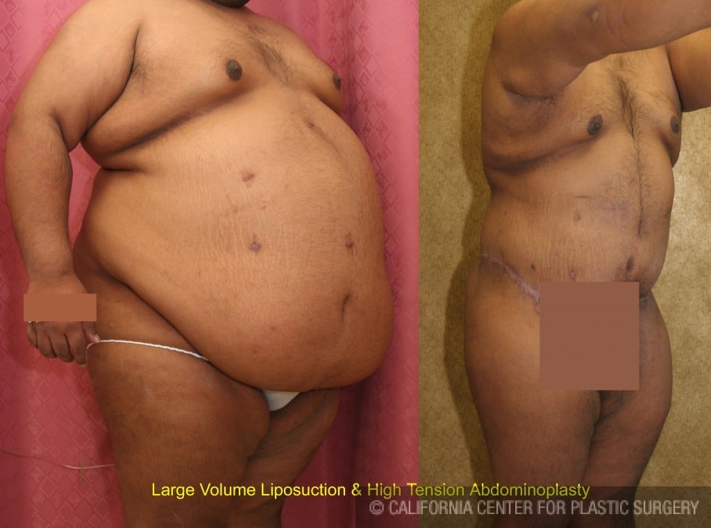 Male Tummy Tuck (abdominoplasty) Before & After Patient #6031