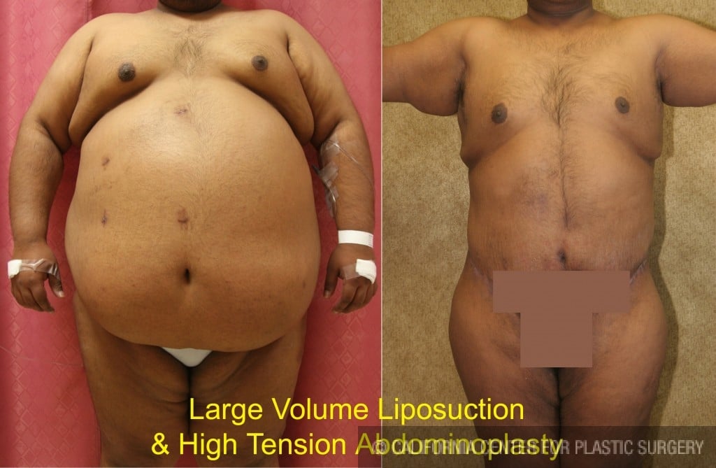 Male Tummy Tuck (abdominoplasty) Before & After Patient #6031