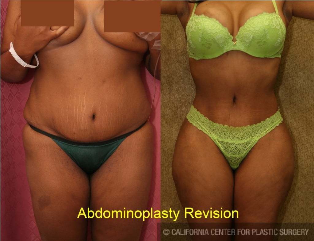 Tummy Tuck Medium Size Before & After Patient #5760