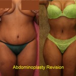 Tummy Tuck (Abdominoplasty) Medium Size Before & After Patient #5760