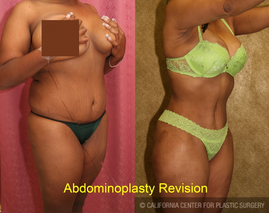 Patient #5760 Tummy Tuck (Abdominoplasty) Medium Size Before and