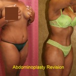 African American Tummy Tuck (Abdominoplasty) Before & After Patient #5919