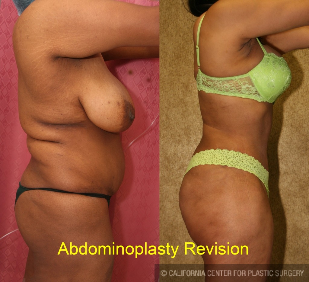 African American Tummy Tuck (Abdominoplasty) Before & After Patient #5919
