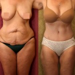 Tummy Tuck (Abdominoplasty) Medium Size Before & After Patient #5821