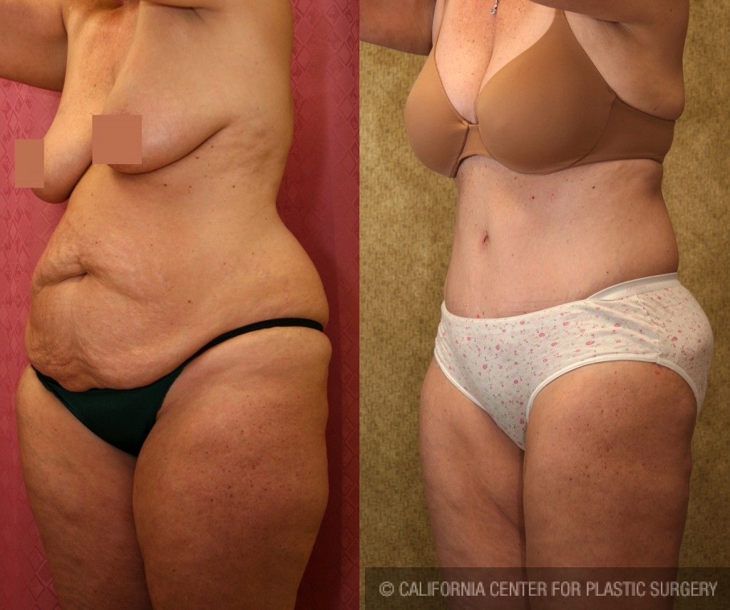 Tummy Tuck (Abdominoplasty) Medium Size Before & After Patient #5821