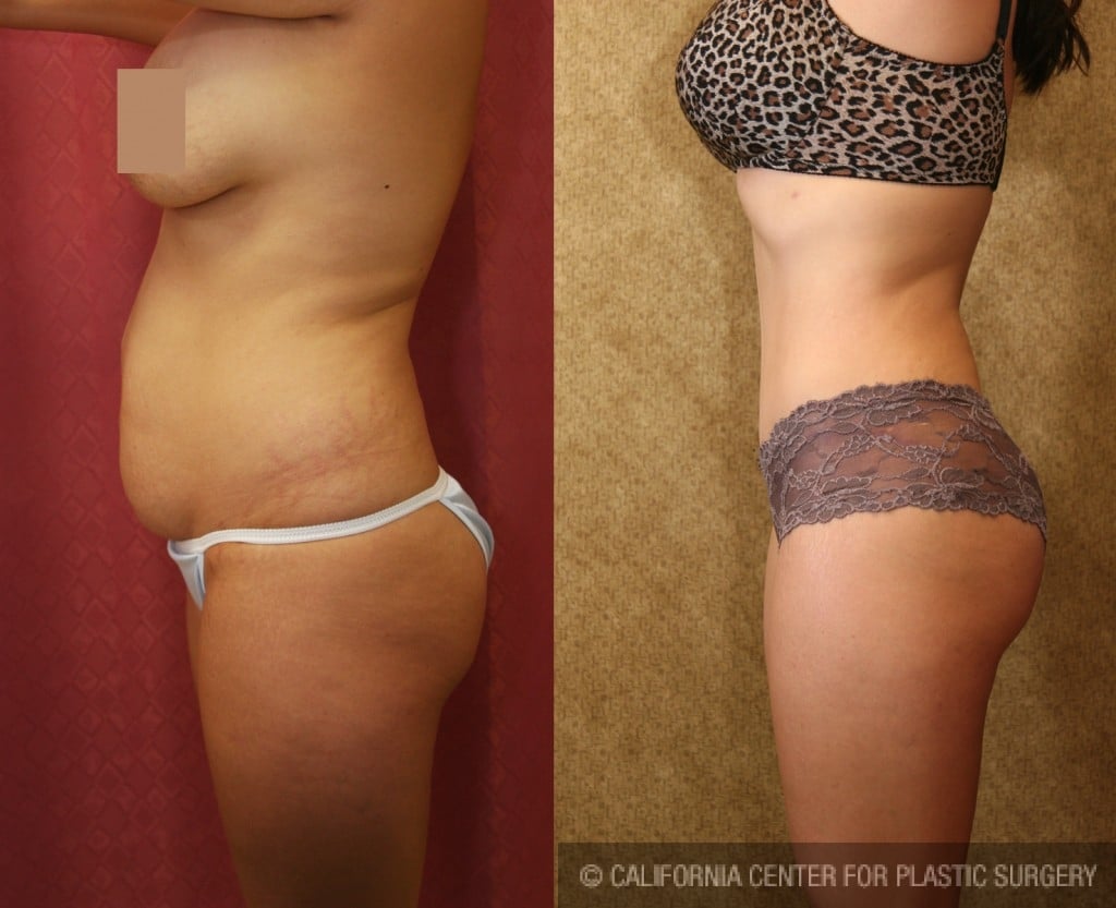 Tummy Tuck (Abdominoplasty) Small Size Before & After Patient #5726
