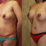 Tummy Tuck (Abdominoplasty) Medium Size Before & After Patient #5825