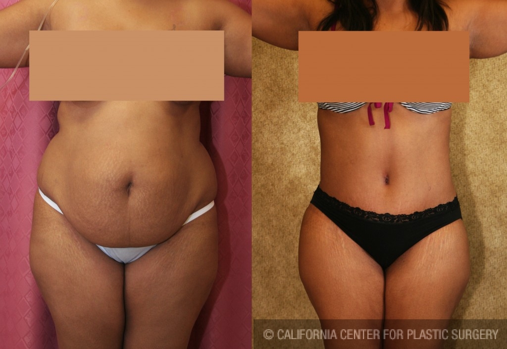 African American Tummy Tuck Before & After Patient #5973