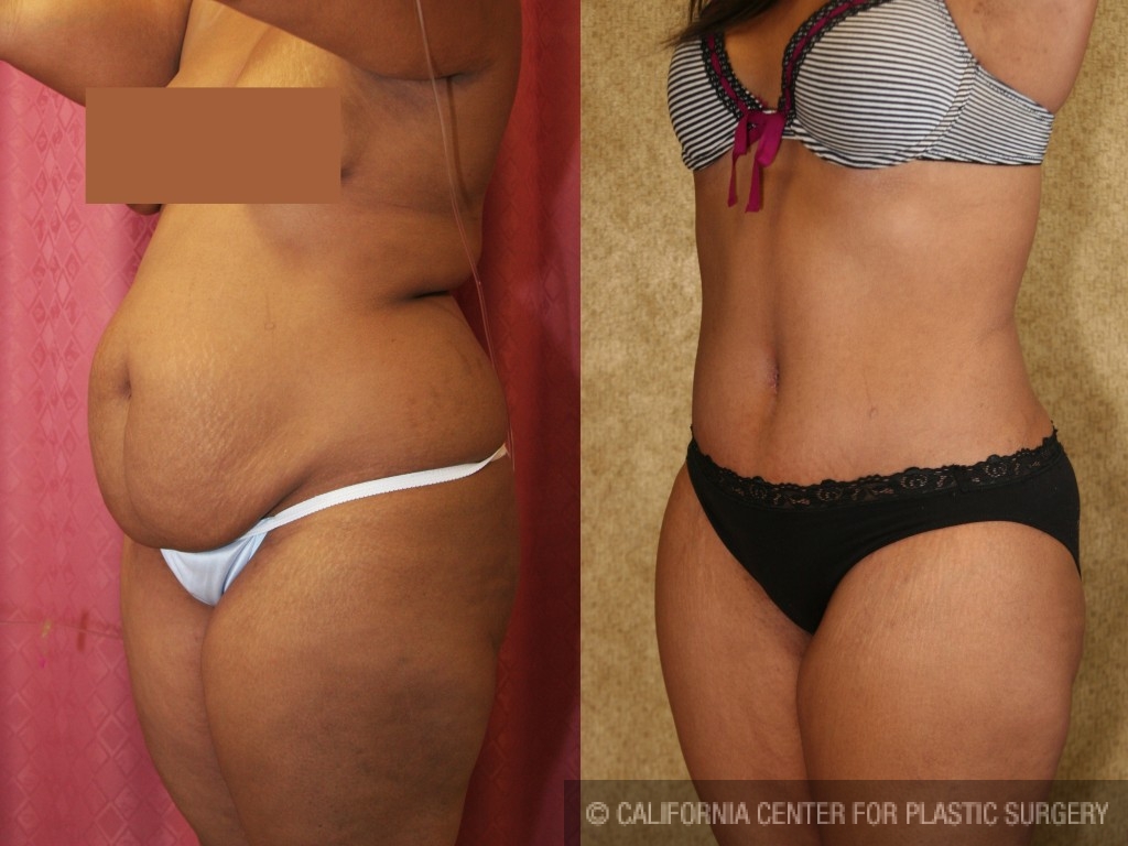 African American Tummy Tuck Before & After Patient #5973