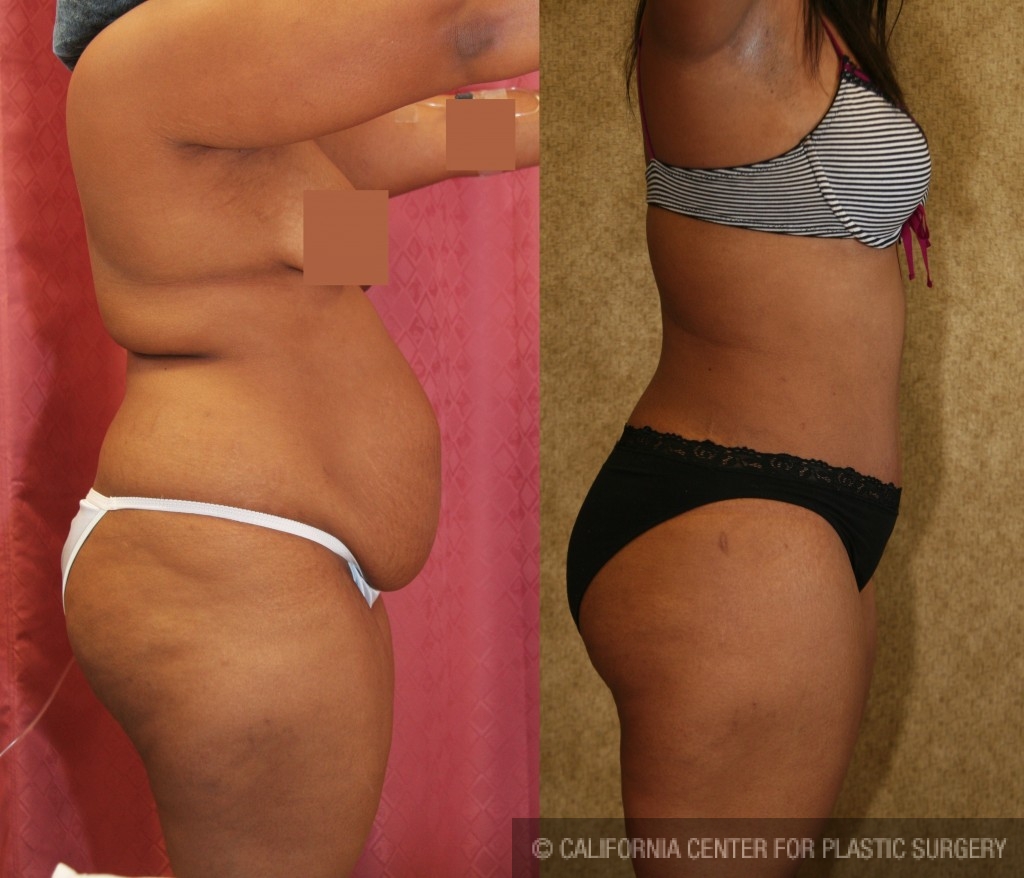 African American Tummy Tuck Before & After Patient #5973