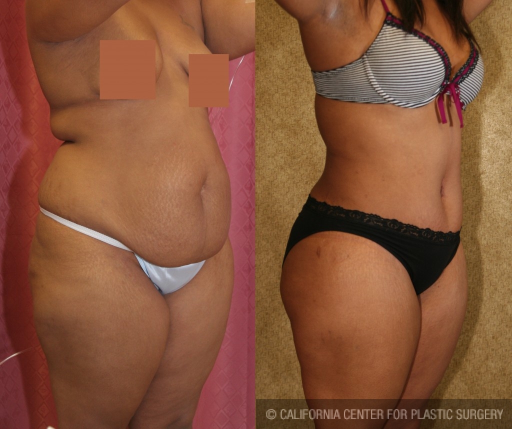 African American Tummy Tuck Before & After Patient #5973