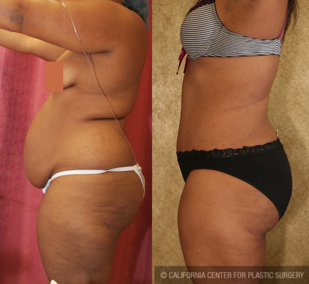 African American Tummy Tuck Before & After Patient #5973