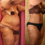 African American Tummy Tuck (Abdominoplasty) Before & After Patient #5944