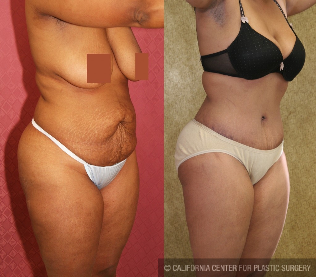 African American Tummy Tuck Before & After Patient #5949