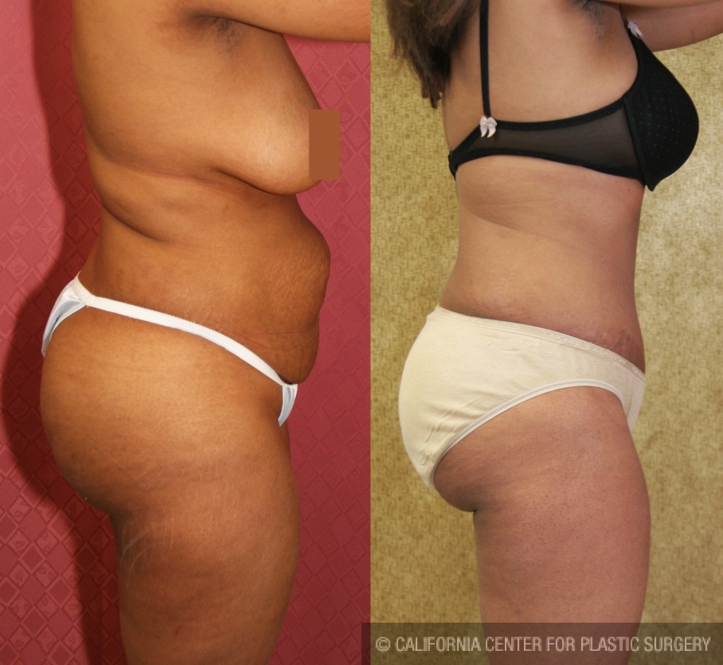 African American Tummy Tuck Before & After Patient #5949