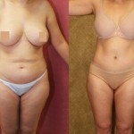 Tummy Tuck (Abdominoplasty) Medium Size Before & After Patient #5859