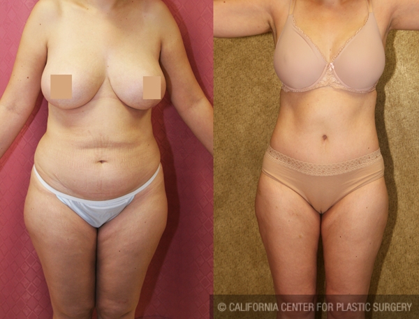 Tummy Tuck (Abdominoplasty) Medium Size Before & After Patient #5859
