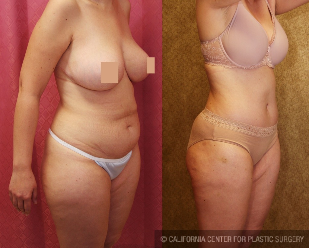 Tummy Tuck (Abdominoplasty) Medium Size Before & After Patient #5859