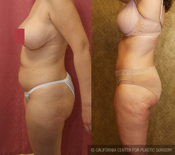 Tummy Tuck (Abdominoplasty) Medium Size Before & After Patient #5859