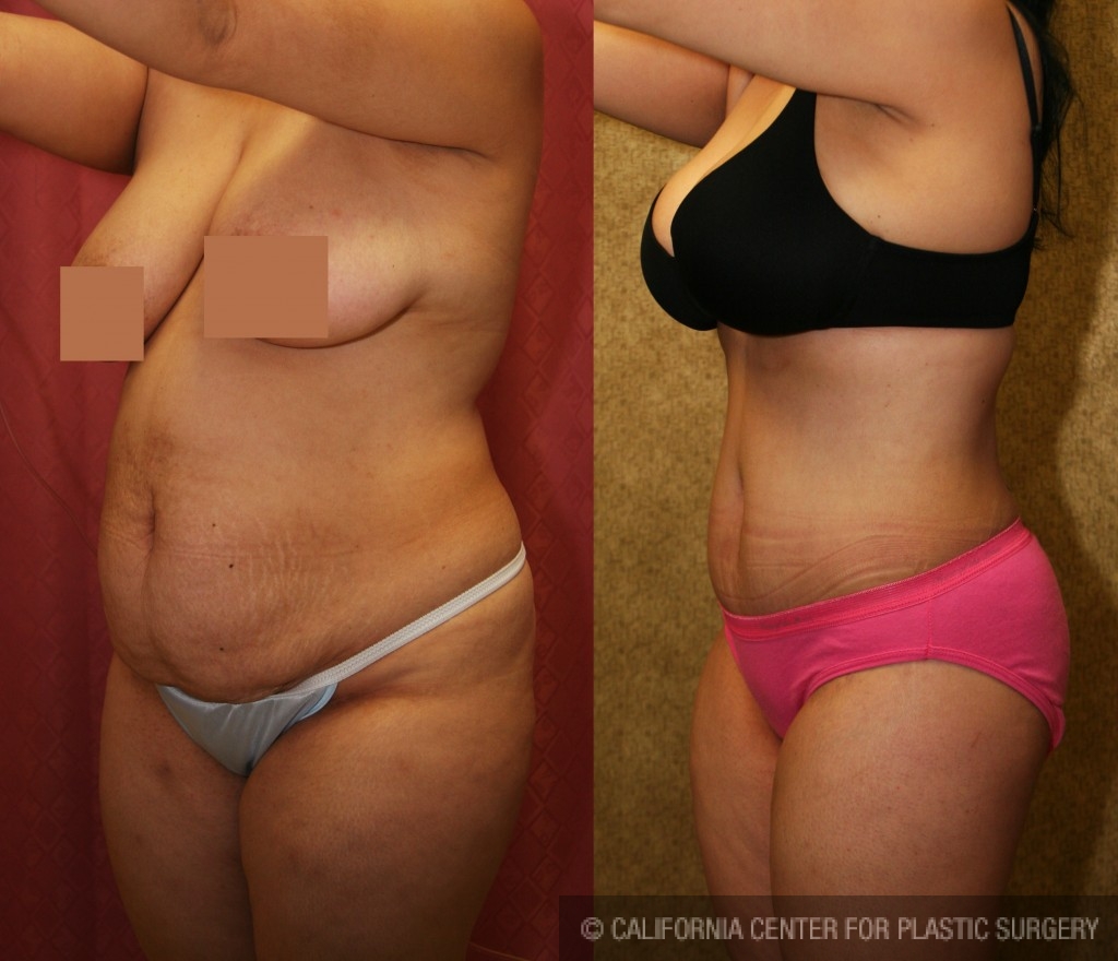 Tummy Tuck (Abdominoplasty) Medium Size Before & After Patient #5777