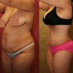 Tummy Tuck (Abdominoplasty) Medium Size Before & After Patient #5777