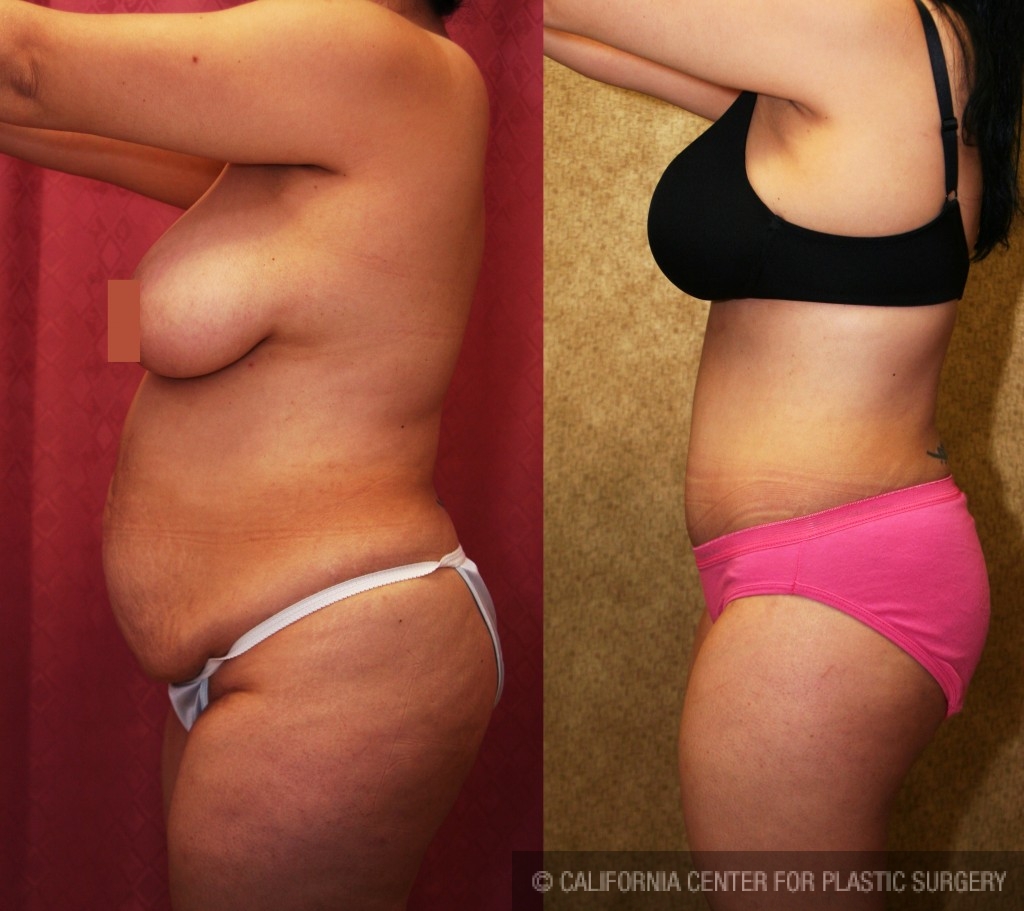 Tummy Tuck (Abdominoplasty) Medium Size Before & After Patient #5777