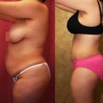 Tummy Tuck (Abdominoplasty) Medium Size Before & After Patient #5777