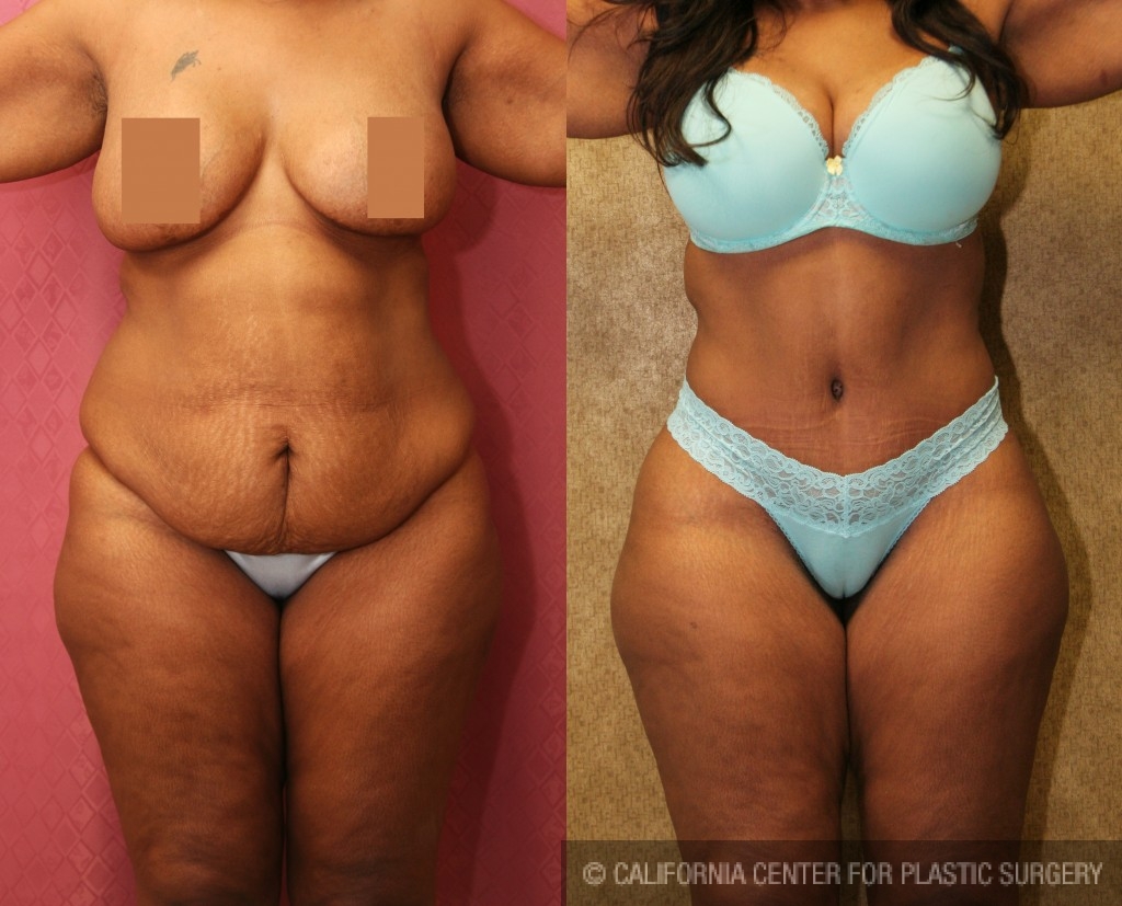 Abdominoplasty Before & After