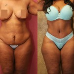 African American Tummy Tuck (Abdominoplasty) Before & After Patient #5924