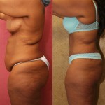 African American Tummy Tuck (Abdominoplasty) Before & After Patient #5924