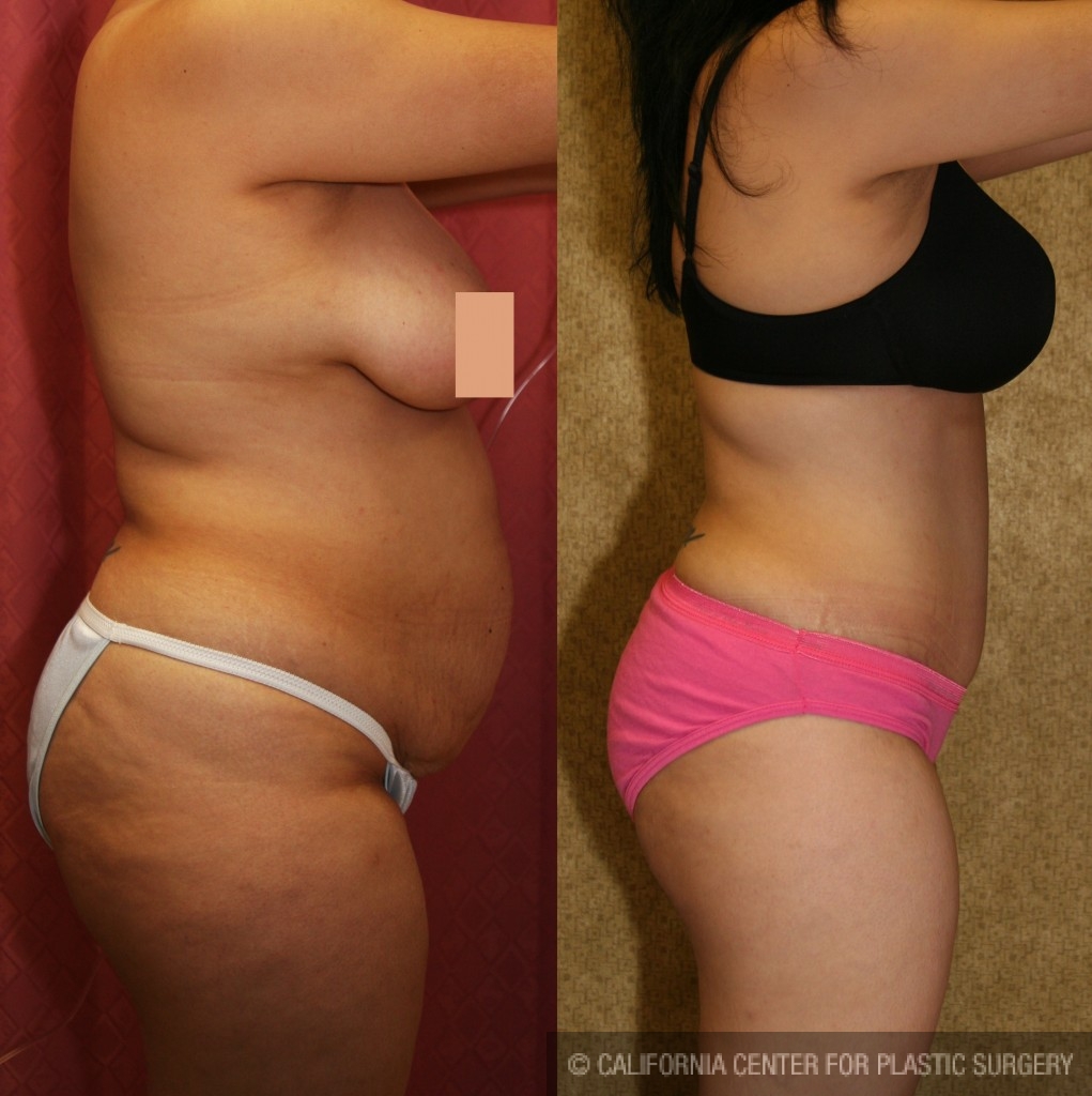 Tummy Tuck (Abdominoplasty) Medium Size Before & After Patient #5777