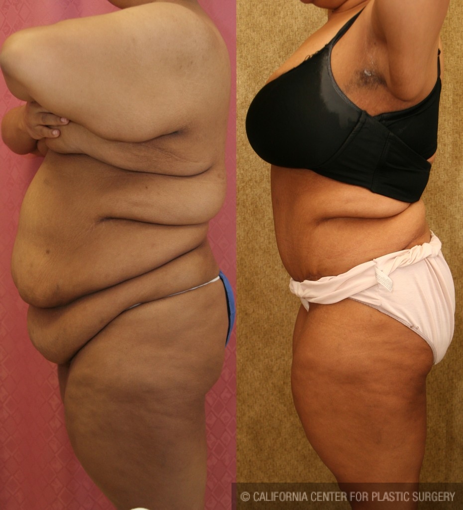 Tummy Tuck (Abdominoplasty) Plus Size Before & After Patient #5880