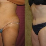 Tummy Tuck (Abdominoplasty) Medium Size Before & After Patient #5869