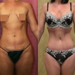 Tummy Tuck (Abdominoplasty) Small Size Before & After Patient #5732