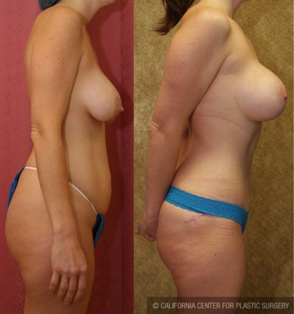 Mommy Makeover Before & After Patient #6005