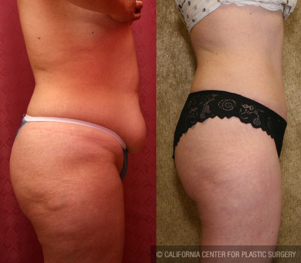 Tummy Tuck (Abdominoplasty) Small Size Before & After Patient #5737