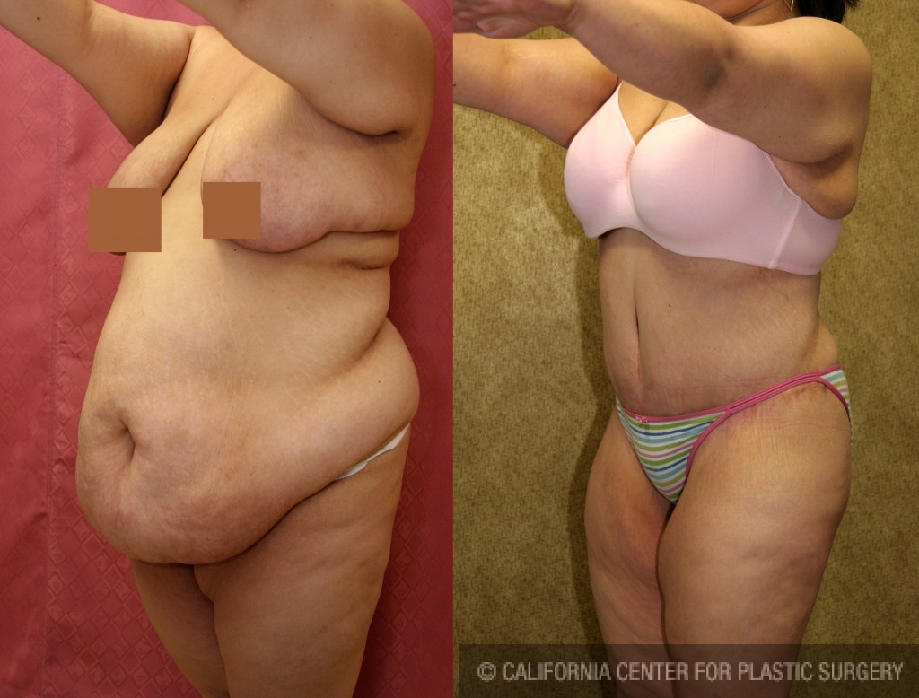 Patient #5874 Tummy Tuck (Abdominoplasty) Plus Size Before and