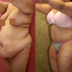 Tummy Tuck (Abdominoplasty) Plus Size Before & After Patient #5874