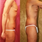 Male Tummy Tuck (abdominoplasty) Before & After Patient #6019