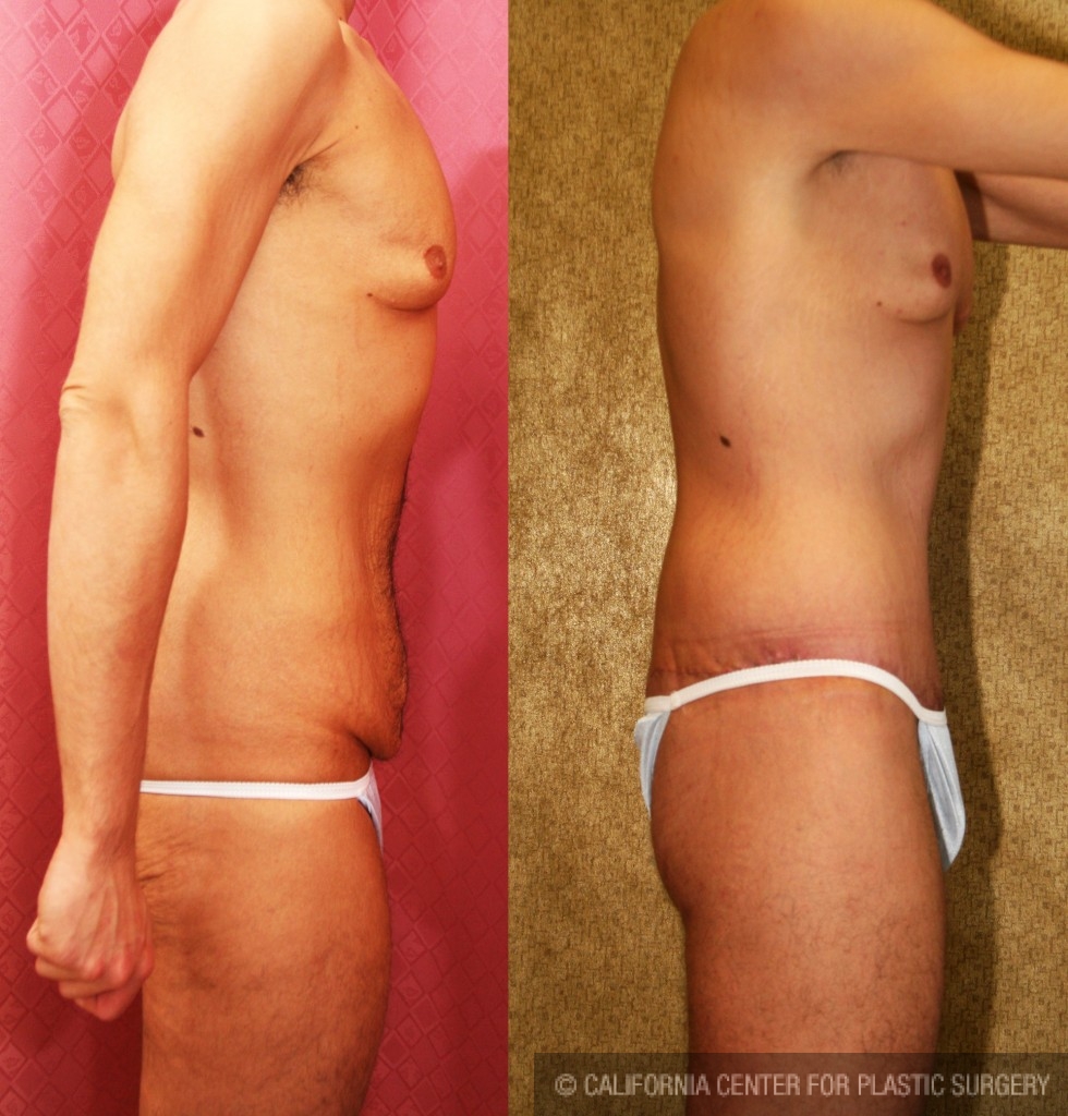 Male Tummy Tuck (abdominoplasty) Before & After Patient #6019