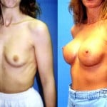 Breast Augmentation Before & After Patient #6415